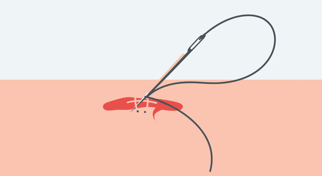 Surgical Stitching: Needle and Thread Repairing Skin Wound