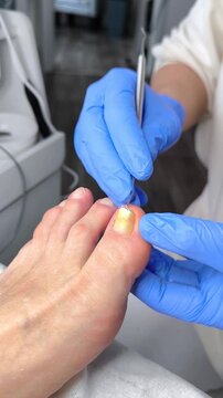 Medical Pedicure. A podologist treats an ingrown toenail on the big toe.