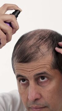 Man hair treatment. Male person who applies a product to stop hair loss. Therapy with lotion in liquid cosmetic spray.