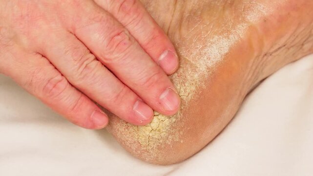 A hand feels a cracked heel in bed. An elderly person's hand touches a heel with deep fissures against a white sheet. Elderly health. The consequences of diabetes. A diseased foot. A hospital ward. 4k