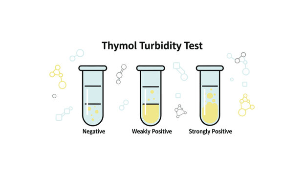 Thymol Turbidity Test results in test tubes. Medical laboratory diagnostic concept for liver function.