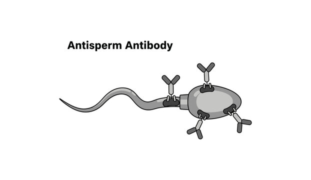 Antisperm Antibody Medical Illustration with Sperm and Y-Shaped Antibodies