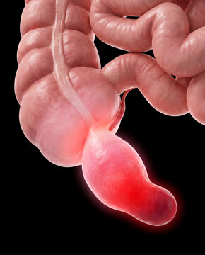 Inflamed appendix and intestines, 3D medical illustration depicting appendicitis with a red highlighted organ on a black background.
