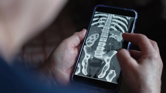 A woman looks at a close-up of an MRI image of kidney stones on a smartphone screen