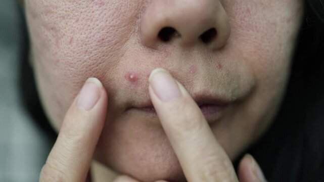 Close up of female face with red problematic acne skin, blurry background 