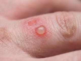 Fototapeta premium close-up of epidermolysis bullosa blister on human skin medical condition