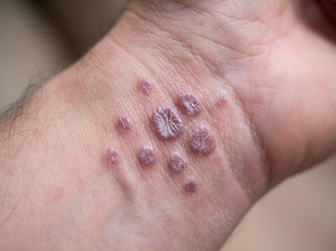 closeup of skin with lichen planus rash on arm medical condition texture
