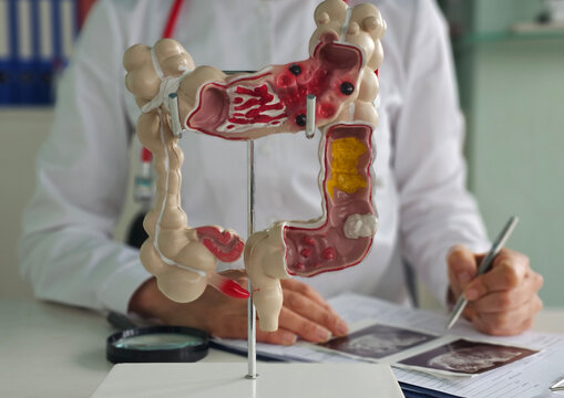 Colon diseases and colorectal cancer and ulcerative colitis concept