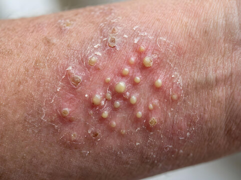 closeup of severe pustular psoriasis on human skin medical condition