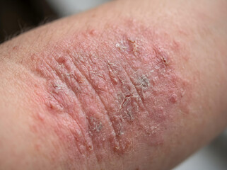Fototapeta premium close-up of human forearm with severe eczema and dry flaky skin texture