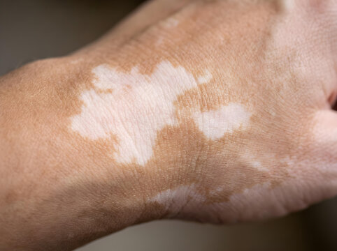 close-up of human hand with vitiligo skin condition in soft natural light