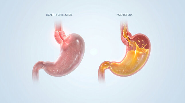 Acid Reflux GERD vs Healthy Lower Esophageal Sphincter Stomach Anatomy