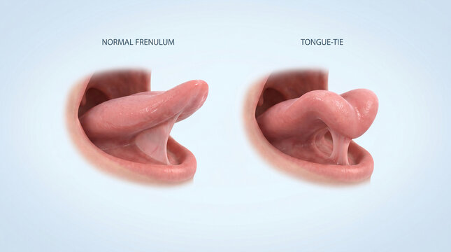 Ankyloglossia Tongue Tie vs Normal Frenulum Medical Illustration