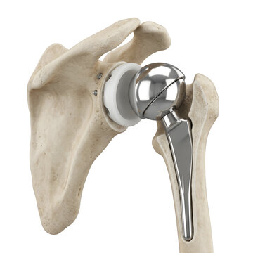 Shoulder joint replacement icon set &mdash; medical illustration