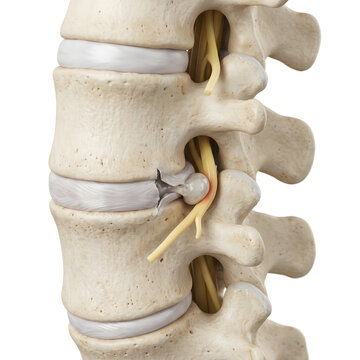 Spinal disc herniation icon set &mdash; medical illustration