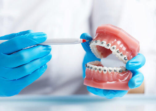 Close up of doctor orthodontist showing model of human jaw with wire braces attached
