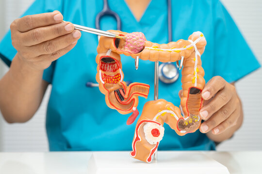 Colorectal cancer, doctor holding intestine colon human model.