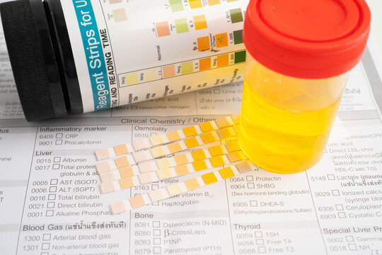 Urinalysis, urine cup with reagent strip pH paper test and comparison chart in laboratory.
