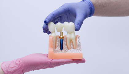 Naklejka premium Dentist hands in blue and pink gloves placing a dental bridge onto an anatomical implant model. Cross-section jawbone.