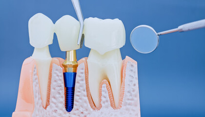 Macro photography of dental prosthodontics: placing a tooth bridge on a titanium implant with...