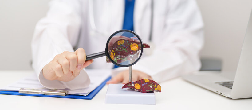 Doctor with human Liver anatomy model. Liver cancer and Tumor, Jaundice, Viral Hepatitis A, B, C, D, E, Cirrhosis, Failure, Enlarged, Hepatic Encephalopathy, Ascites Fluid in Belly and health concept