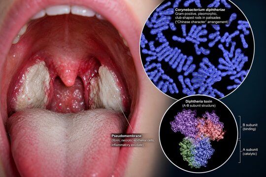 Medical illustration of diphtheria infection showing a swollen throat with pseudomembrane, corynebacterium diphtheriae bacteria, and the diphtheria toxin molecular structure