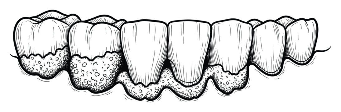 Detailed line drawing of human teeth with inflamed gums, ideal for educational content on oral hygiene