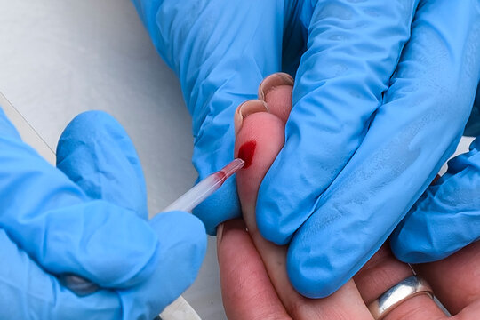 Close-up of a healthcare worker in blue nitrile gloves collecting a capillary blood sample from a patient's fingertip using a glass capillary tube for medical testing and diagnostics.