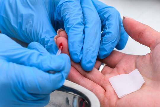 Close-up of a healthcare worker in blue nitrile gloves collecting a capillary blood sample from a patient's fingertip using a glass capillary tube for medical testing and diagnostics.