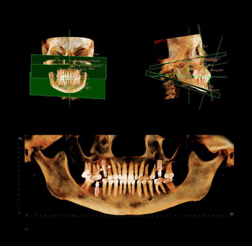 Computed tomography of adult female patient with Temporomandibular joint (TMJ, joint of lower jaw). Dental x-ray of an adult patient showing teeth, jaws and mandibular joint. Modern digital tomography