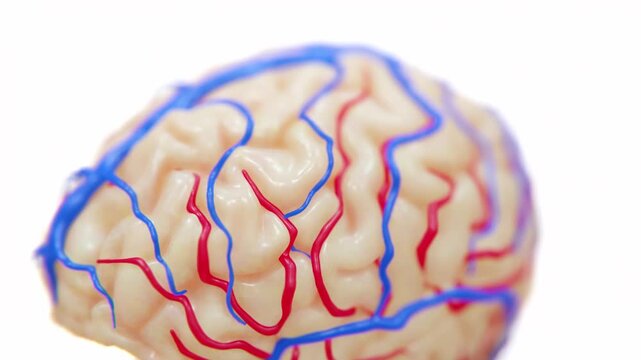 A video of brain stroke occurs shows when blood flow to part of the brain is blocked or interrupted, causing brain cells to become damaged due to lack of oxygen in 4K