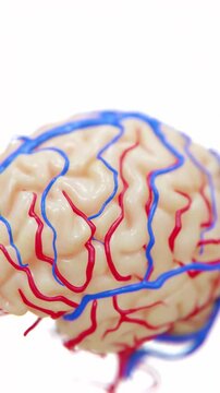 A video of brain stroke occurs shows when blood flow to part of the brain is blocked or interrupted, causing brain cells to become damaged due to lack of oxygen in Verical Format