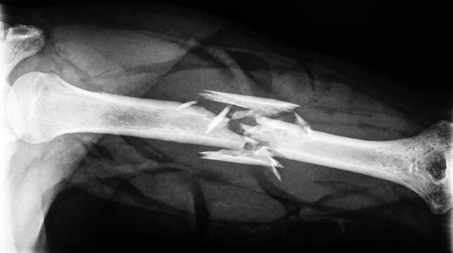 X-ray image of a fractured humerus bone stabilized with internal fixation hardware