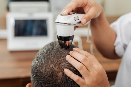 Close up of digital scalp analyzer examining a healthy middle aged man&rsquo;s scalp and hair follicles for scalp assessment and hair wellness monitoring.