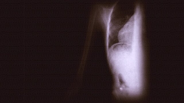 Vintage 1930s Fluorography Footage &ndash; Rapid X-Ray Sequence on Scratched 35mm Sepia Film