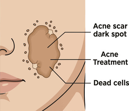 Create a realistic Acne scar dark spot and dead cells on facial skin for acne treatment concept. Vector art with white background.