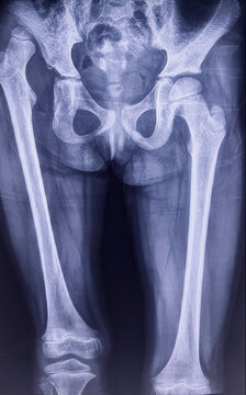 Pediatric pelvic and bilateral femur radiograph displaying a right hip dislocation and open growth plates. X ray showing developmental dysplasia of hip . 
