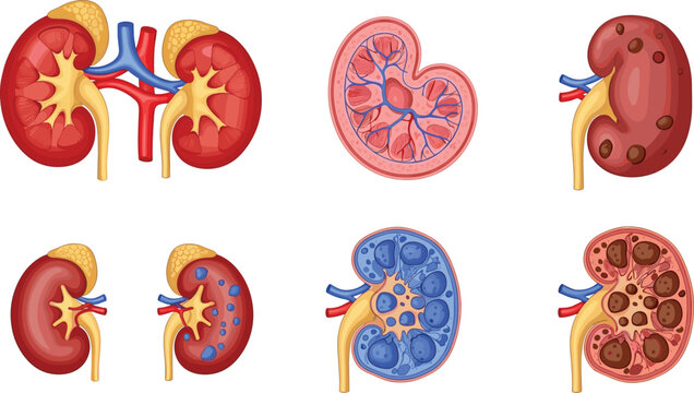 Kidney Anatomy and Disease Vector Illustrations Featuring Healthy and Diseased Kidney Structures for Medical Education