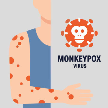 Monkeypox Virus Infection Symptoms on Human Skin Design, Monkeypox Outbreak Medical Concept with Pustules and Virus Symbol