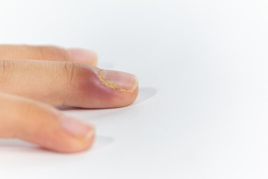 Acute Paronychia Finger Infection with Red Swollen Skin and Pus Near Nail Cuticle