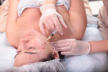 Fototapeta premium Facial plasmolifting procedure. Injections of plasmolifting in beauty salon. Biomaterials of patient. Patient's face in close-up. Concept of cosmetology