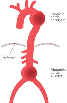 大動脈瘤のイラスト　Illustration of an aortic aneurysm