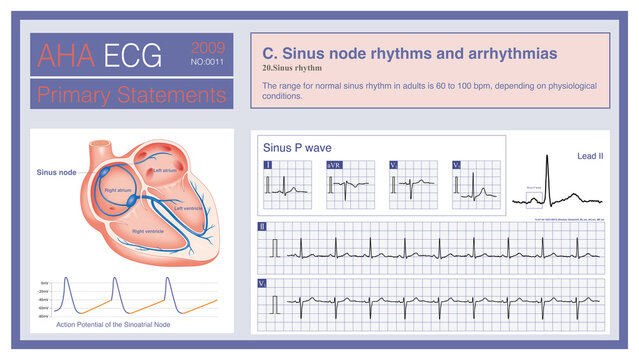 Sinus rhythm is a heart rhythm originating from the sinoatrial node; it is the normal source of heart rhythm in most individuals. Sinus rhythm is generated by pacemaker cells located within the SA nod