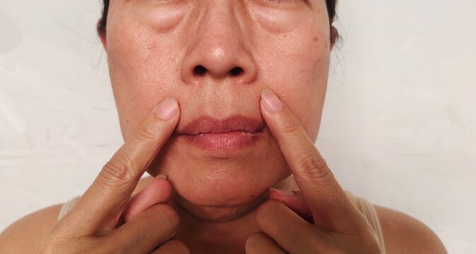 portrait the fingers holding the flabbiness and lines beside the mouth, Flabby skin and scar, swelling and ptosis under the eyes, freckles and blemish on the face, health care and beauty concept.