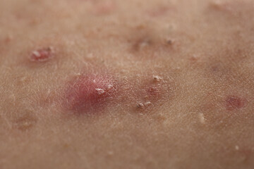 Fototapeta premium Acne skin pimple. Skin problem with inflamed bumps. Irritated skin texture. Close up skin issue.