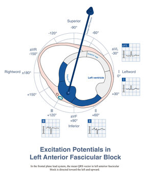 In the presence of left anterior fascicular block, the region of the left posterior fascicle is activated first, followed by the region of the left anterior fascicle; the overall activation potential 