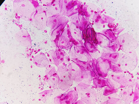 HVS for gram stain. Gram positive bacilli seen. Suggestive of lactobacilli.