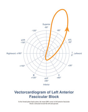 In the presence of left anterior fascicular block, the region of the left posterior fascicle is activated first, followed by the region of the left anterior fascicle; the overall activation potential 