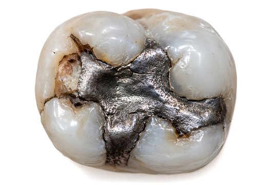 Macro view of a human molar tooth with an old silver amalgam filling and cracked enamel, isolated on a white background.