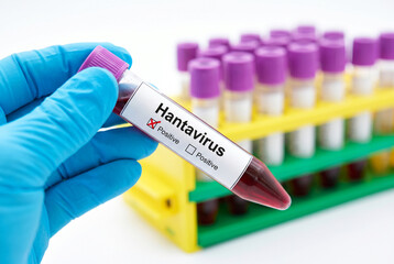 Fototapeta premium Positive hantavirus blood test in medical tube with laboratory rack